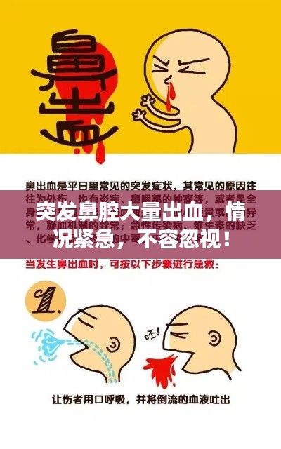 突发鼻腔大量出血,情况紧急,不容忽视!