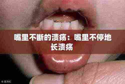 嘴里不断的溃疡:嘴里不停地长溃疡